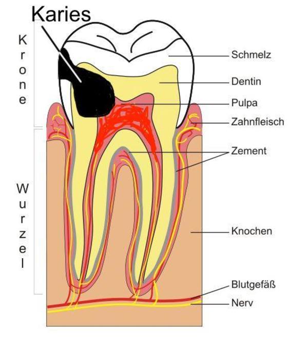 Wurzelbehandlung